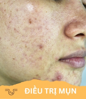 Điều trị mụn