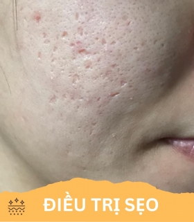Điều Trị Sẹo