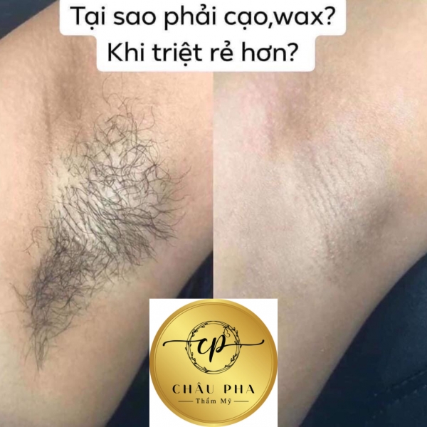 TRIỆT LÔNG VĨNH VIỄN NHƯ THẾ NÀO? GIÁ BAO NHIÊU? BẢNG GIÁ MỚI NHẤT THÁNG 3/2023