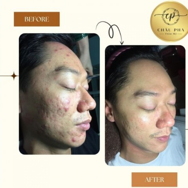 Điều Trị Mụn Liệu Trình