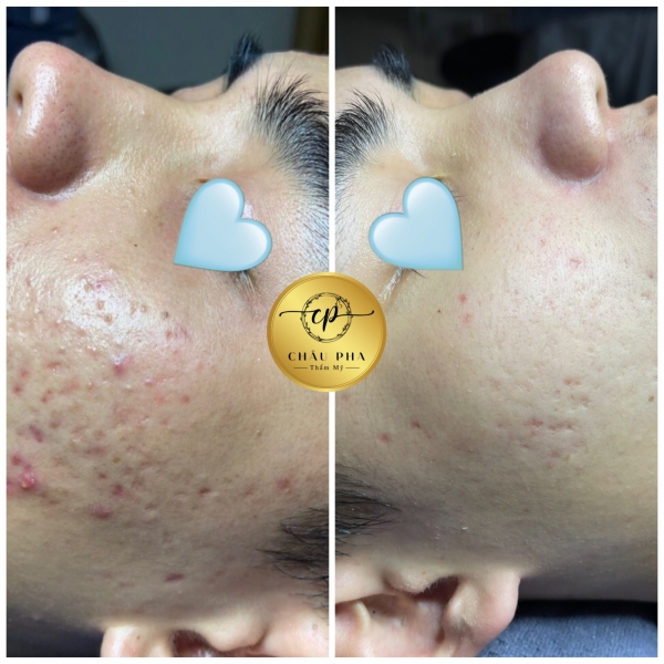 Liệu Trình Mụn _ Thâm Đỏ