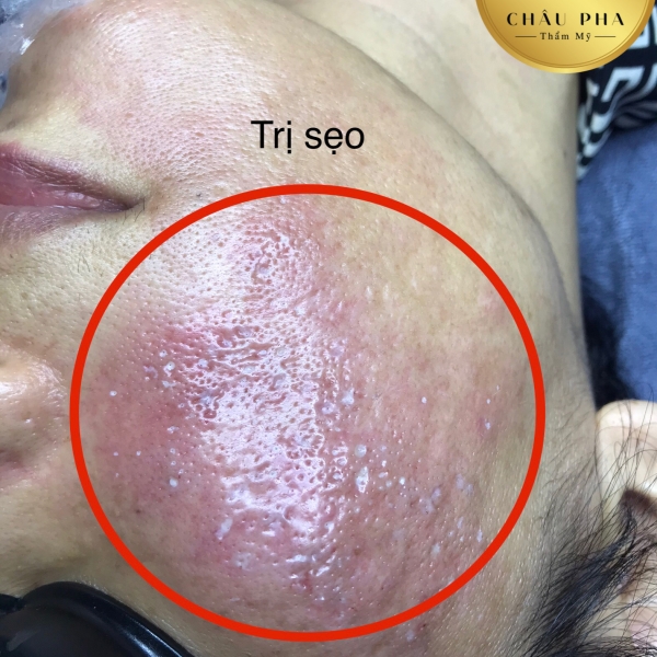 Điều Trị Sẹo Combo 4 Lần