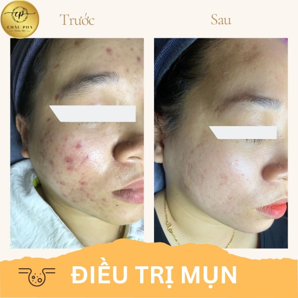 Điều Trị Mụn Liệu Trình