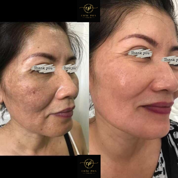 Nám mảng - nội tiết