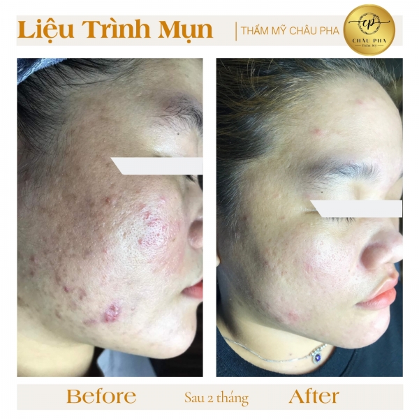 Điều Trị Mụn Liệu Trình