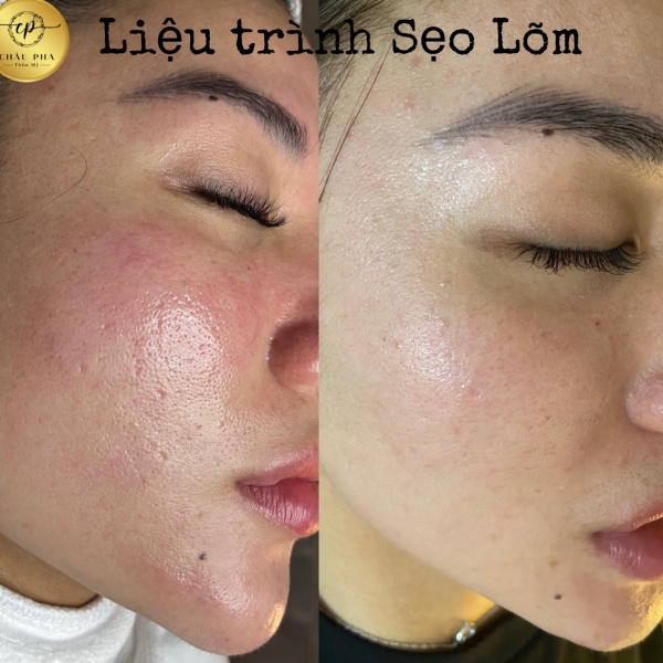 Liệu Trình Sẹo