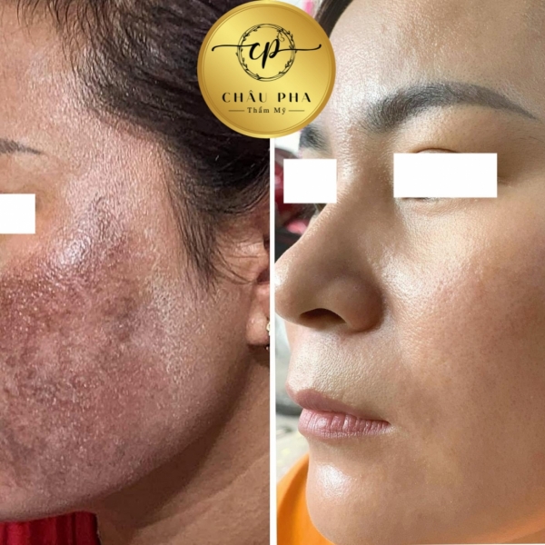 Liệu trình Nám - Perfect Skin