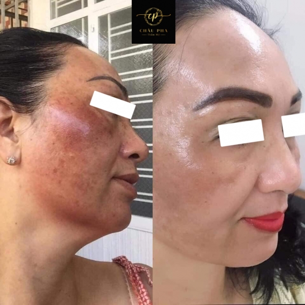 Điều Trị Nám Nắng