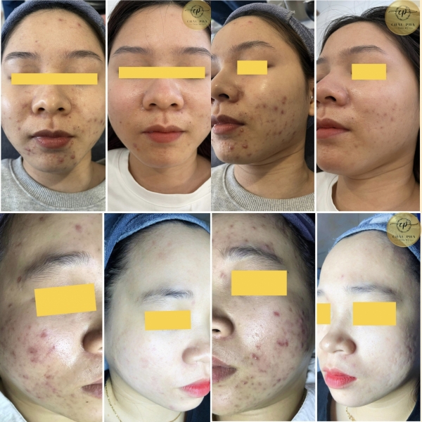 THẨM MỸ CHÂU PHA -CHUYÊN ĐIỀU TRỊ MỤN, NẶN MỤN  CHUẨN Y KHOA BẰNG TĂM BÔNG KHÔNG SƯNG KHÔNG ĐAU