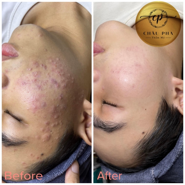 Liệu Trình Mụn - Thâm