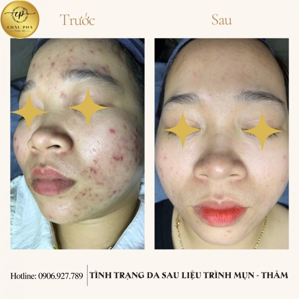 Liệu Trình Trị Thâm Mụn