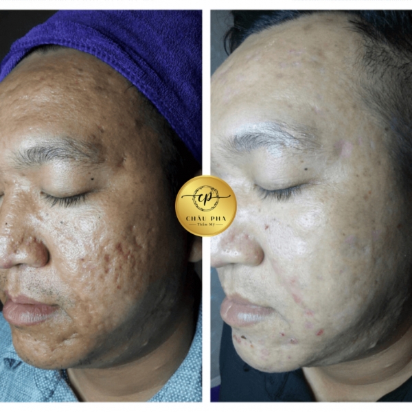 Trị Sẹo Rỗ - Da Dày Sừng