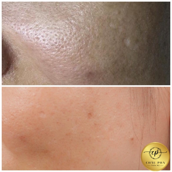 Trị Sẹo Rỗ - Lỗ Chân Lông To