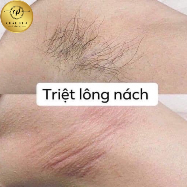 Triệt Nách Bảo Hành Vĩnh Viễn