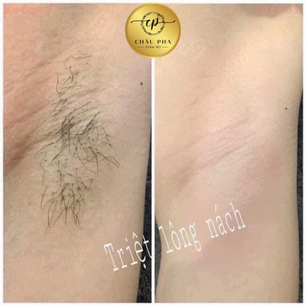 Triệt Nách Bảo Hành Vĩnh Viễn